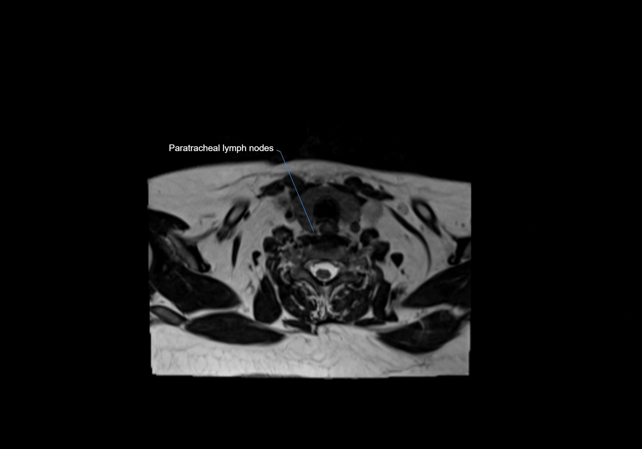 Neck axial  lymph node cross sectional MRI anatomy 3T MRI  image-img-00001-00081.webp